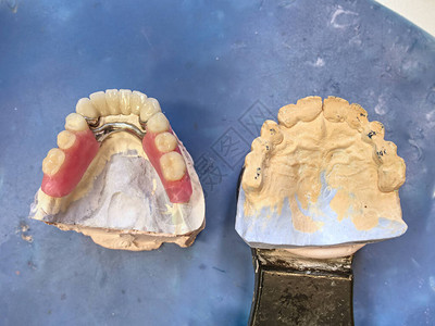 牙科植入带有陶瓷假牙和金属假肢的石膏下巴图片