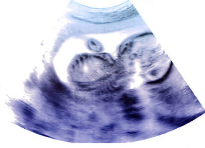 怀孕期间母亲子宫超声图片