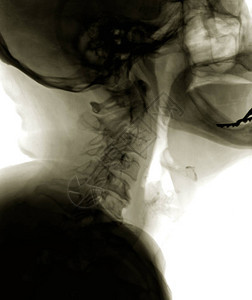 患者的诊断头部X光片侧视图图片