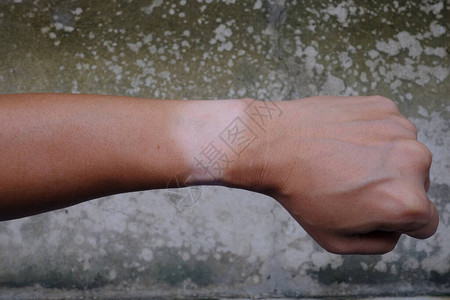 左手腕表的伤痕皮肤背景图片