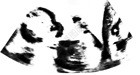 胎儿超声母亲的子宫超声检查图片
