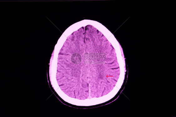 脑梗塞患者右腿无力的CT扫描显示左内囊后肢的低密度区域图片