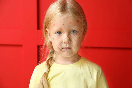 彩色背景上患水痘的小女孩图片