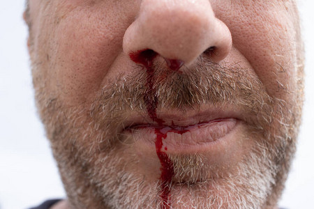 卡通流鼻血图片