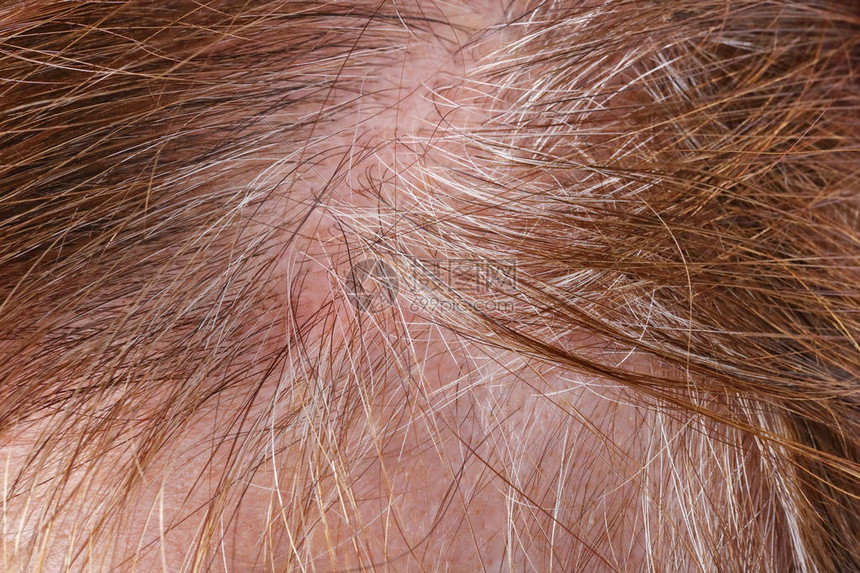 Plötzlich Schwarze Haare Auf Dem Kopf