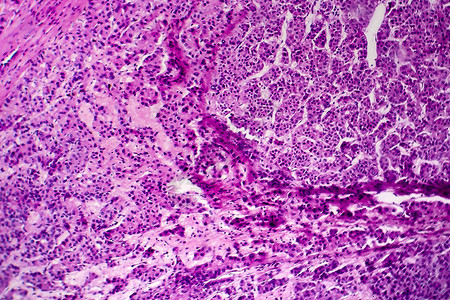 肝细胞癌肝癌轻显微镜显高清图片肝细胞癌肝癌轻显微镜显高清图片更新