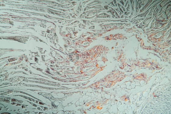 200x显微镜下有氨基质组织病图片