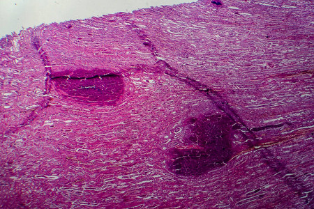 急白血炎轻显微镜显背景图片