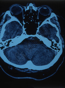 射线图像中带大脑的人头图片