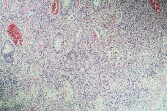 克罗恩病中的结肠炎症100x图片