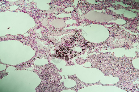 肺组织作为显微镜下的粉尘图片