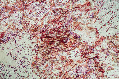 Candida和Aspergillus感染艾滋图片