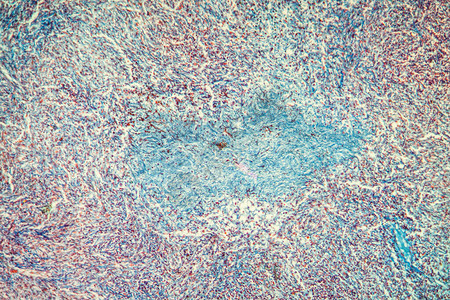 显微镜下胆囊组织癌症100x图片