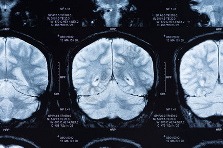 Ct扫描的脑部图片