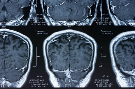 磁共振图像大脑的mri扫描图片