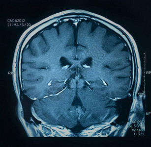 磁共振图像大脑的mri扫描图片
