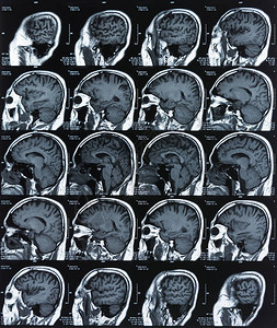 脑部X光胶片图像由MriCt扫描图片