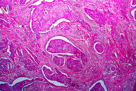 子宫基细胞癌光显微镜显背景图片