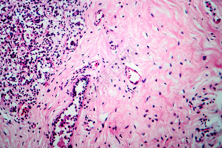 乳腺细胞纤维化轻显微镜显微镜下照片图片