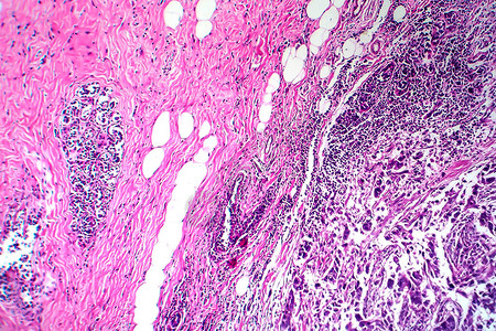 乳腺导管癌光学显微照片显微镜下的照片高清图片