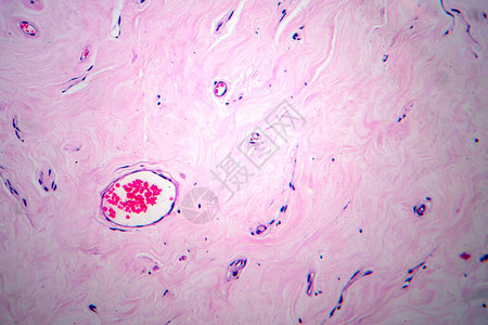 子宫腺纤维瘤图片