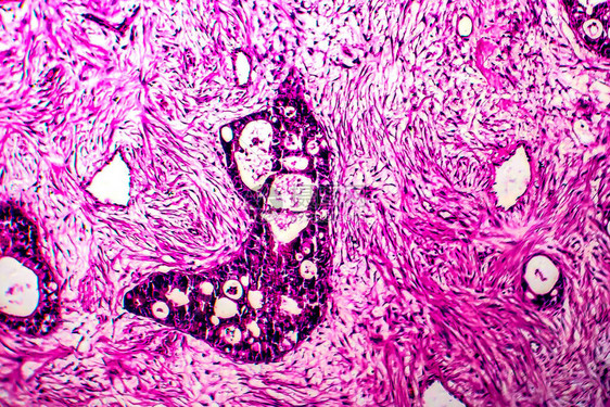 子宫癌轻显微镜显图片
