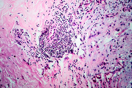 乳腺细胞纤维化轻显微镜显微镜下照片高清图片