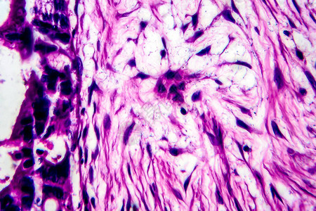 子宫癌轻显微镜显背景图片