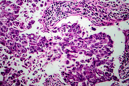 乳腺导管癌光学显微照片显微镜下的照片高清图片