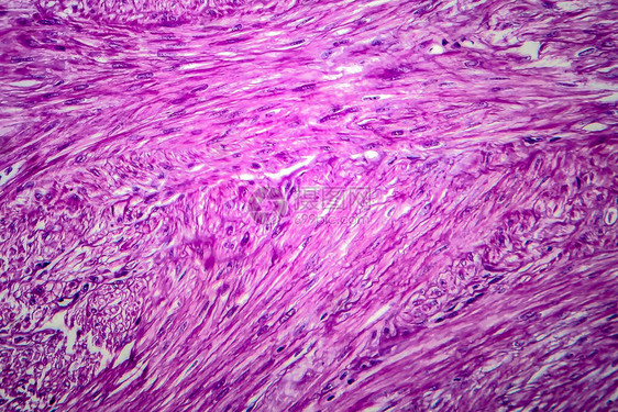 是良子宫滑动肌肉肿瘤光显微镜显图片
