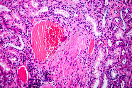 高血压肾脏病光显微摄影显微镜下照片图片