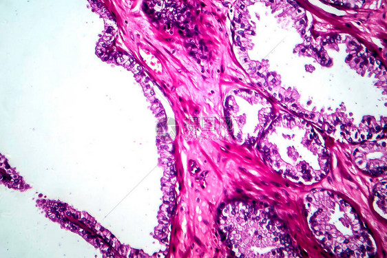 前列腺癌轻显微镜显图片