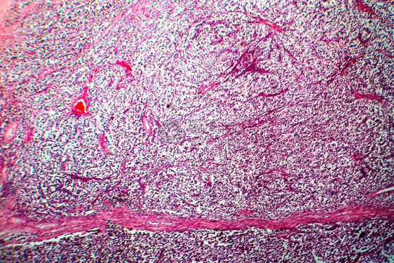 睾丸精原细胞瘤图片
