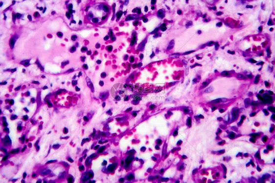 内膜肾炎光显微镜显微镜下照片图片