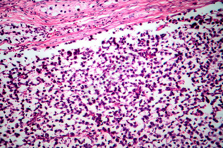 睾丸精原细胞瘤背景图片
