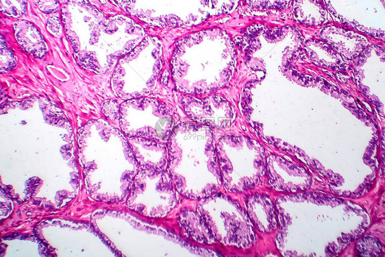 前列腺癌轻显微镜显图片