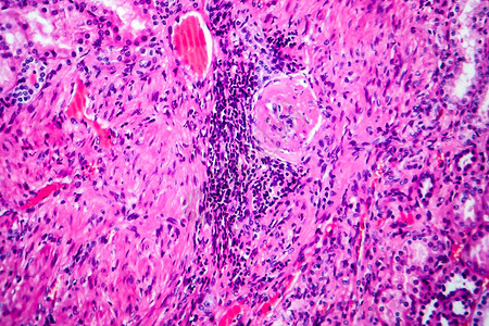 高血压肾脏病光显微摄影显微镜下照片图片