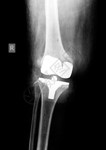 放射学经典X射线的射线胶片图片