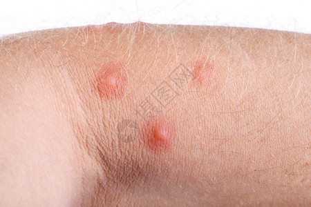 男皮肤手臂上过敏丘疹的宏图片
