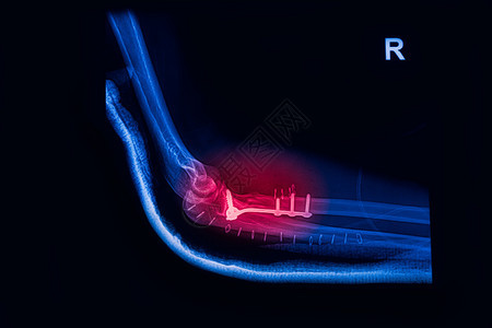 骨折Elbow前臂X射线图像显示板图片
