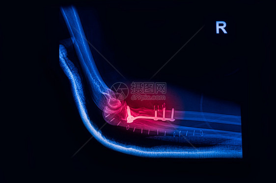 骨折Elbow前臂X射线图像显示板图片