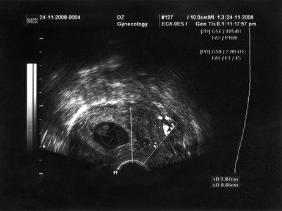 胎儿的超声图像图片