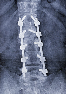 脊柱固定图库片图片