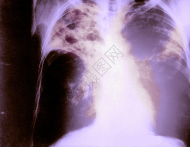 诊断患有高级双肺结核病的图片