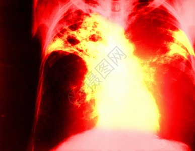 肺结核x艺术背景图片
