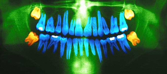 牙科全景X射线智齿背景图片