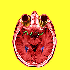 大脑前动脉和内侧动脉的亮点图片