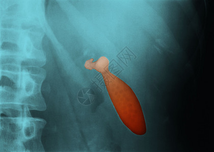 肾结石x光片图片