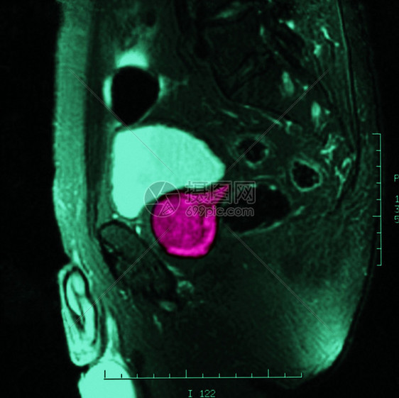 肿瘤伦琴图片