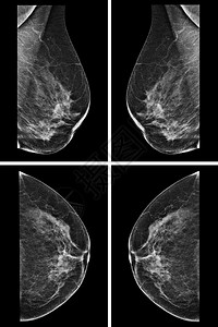 女乳房的侧位乳房X线照片在更高的放大倍数下背景图片